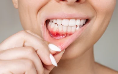Lesioni da decubito del cavo orale: un problema spesso sottovalutato